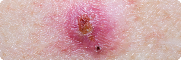 A close-up photograph of a basal cell carcinoma which, in this case, presents as a scab-like crust with red and inflamed surrounding skin.
