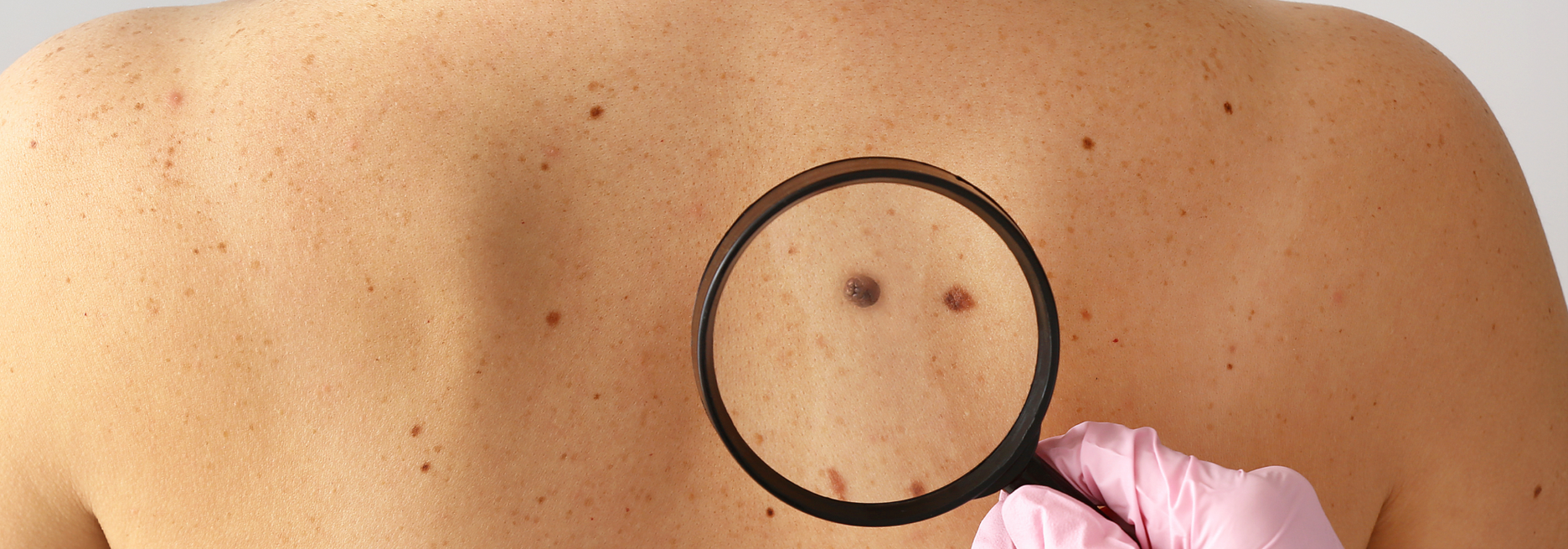 A hand wearing a pink glove holds a magnifying glass and examines a mole in between the shoulder blades.