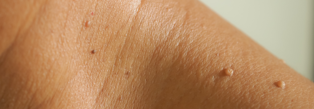 A close up photo of a person's neck and top of shoulder with several skin tags.