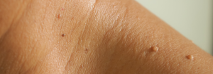 A close up photo of a person's neck and top of shoulder with several skin tags.