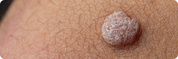 A close-up photo of a wart with some surrounding hair and skin.