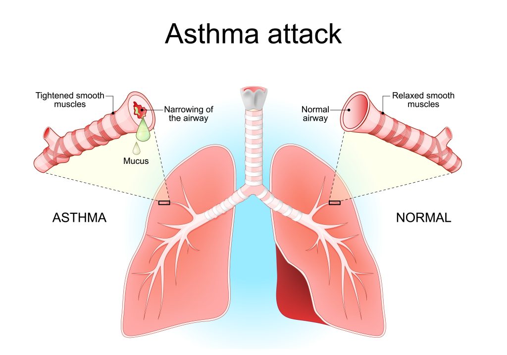 A diagram of the lungs showing left side with asthma - tightened smooth muscles and narrowing of the airway with mucus versus 'normal' which has normal airway and relaxed smooth muscles.
