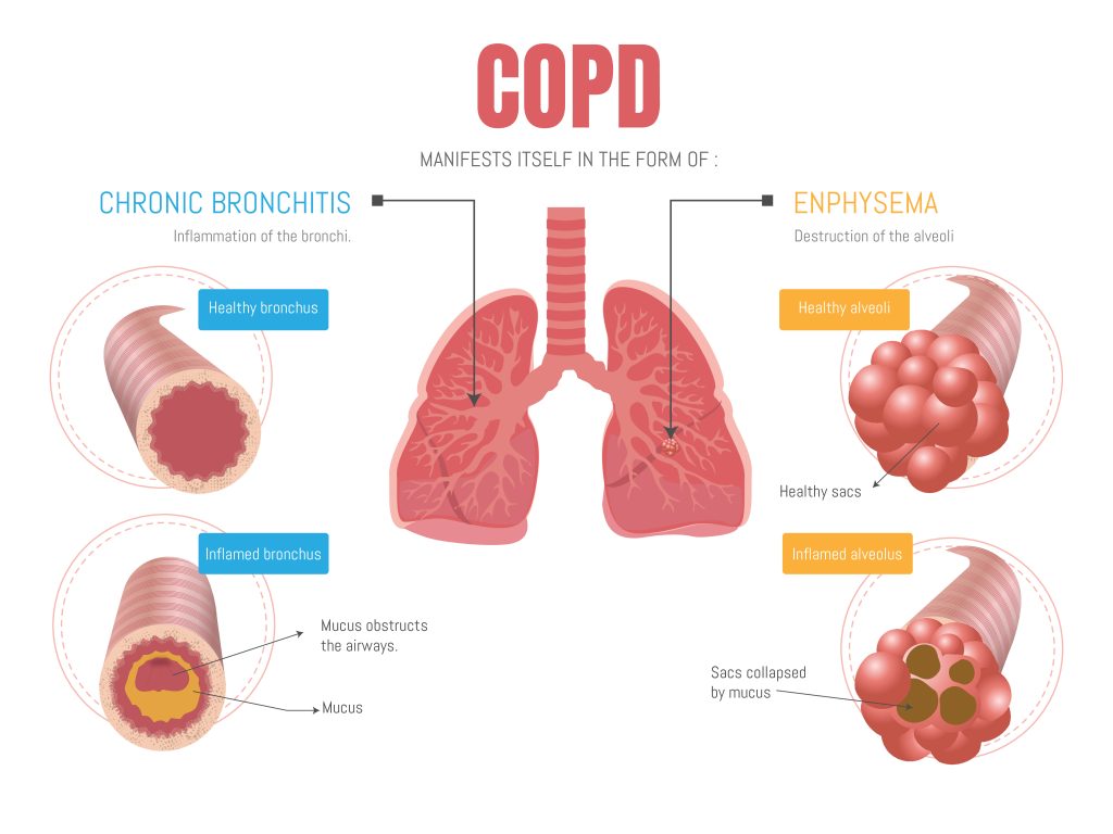 A diagram showing COPD manifests in the form of: Chronic bronchitis (inflammation of the bronchi) and emphysema (destruction of the alveoli).