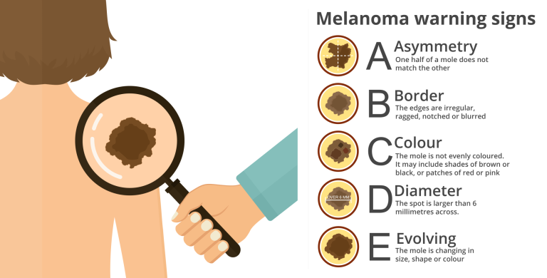A graphic showing a mole in a magnifying glass on someone's back. The graphic is titled 'Melanoma warning signs' with A for Asymmetry - one half of a mole does not match the other, B for Border - The edges are irregular, ragged, notched, or blurred, C for Colour - The mole is not evenly coloured. It may include shades or brown or black, or patches of red or pink, D for Diameter - The spot is larger than 6 millimeters across, and E or Evolving - The mole is changing in size, shape or colour.